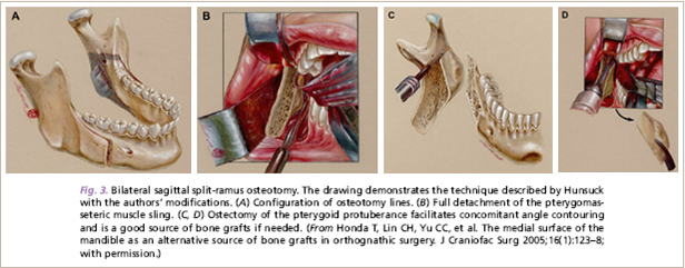 Indication of surgery